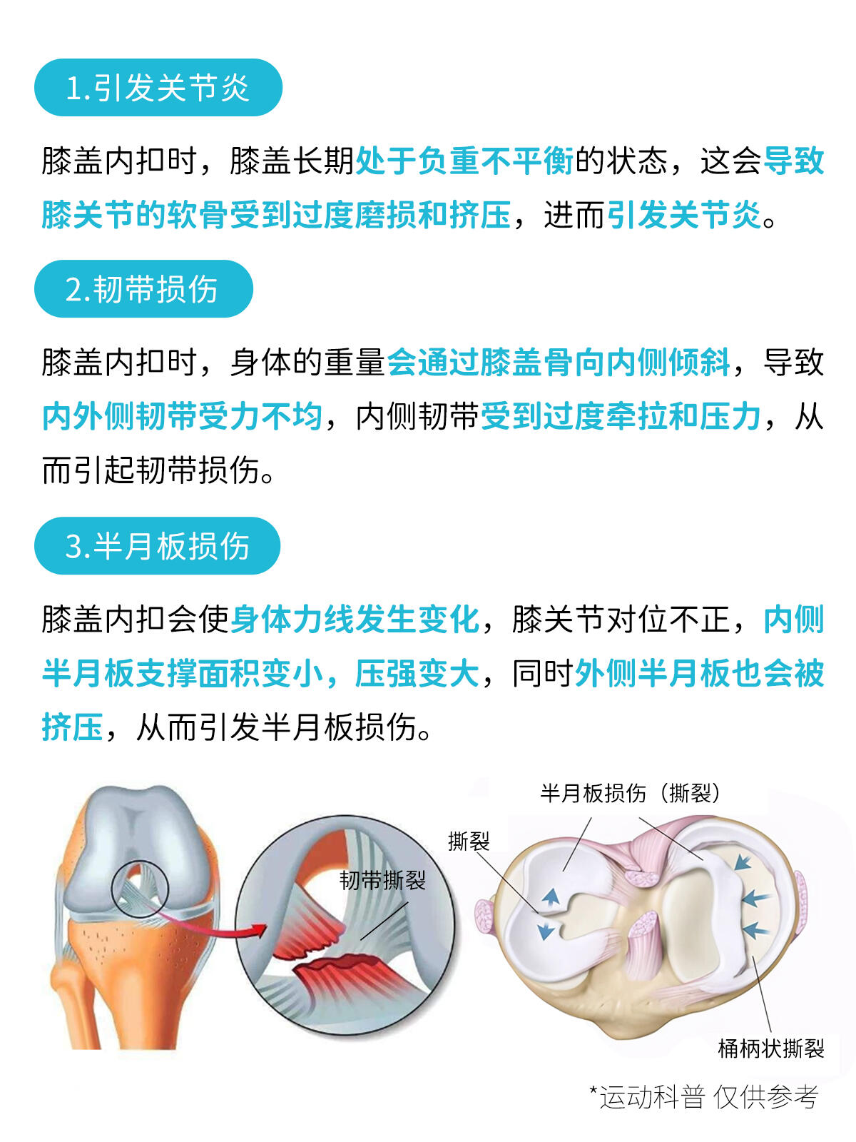 膝盖内扣的3大危害,附矫正方法!