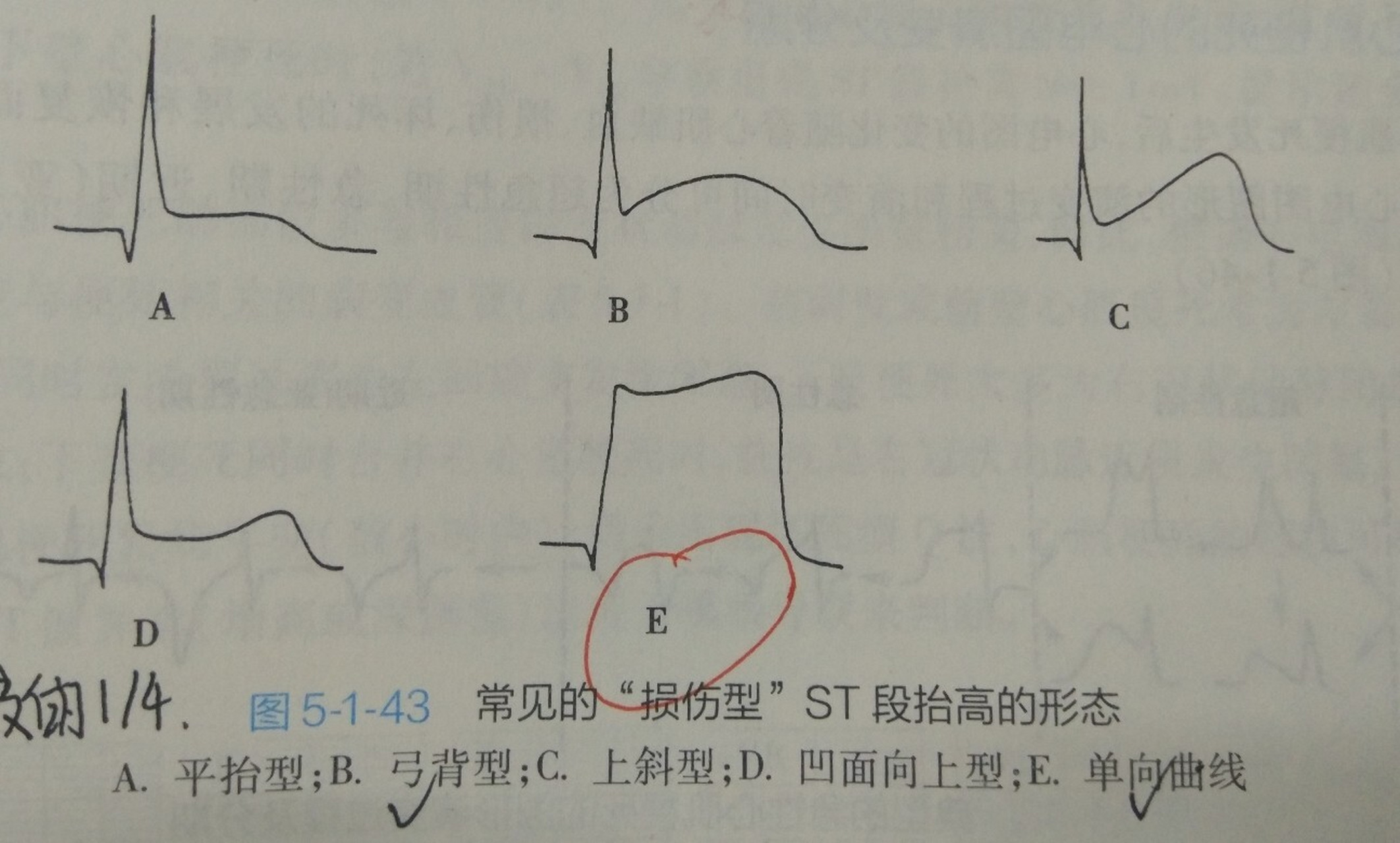 右心房肥大的心电图图片