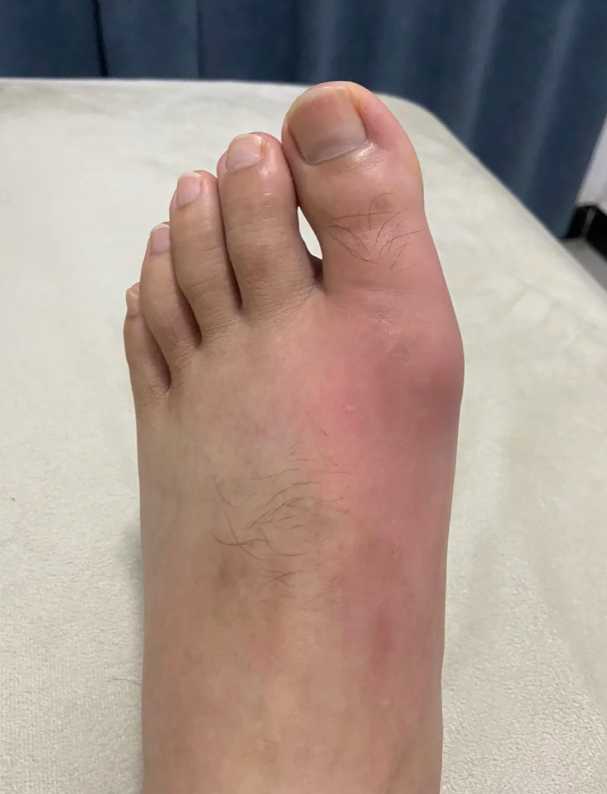 尿酸高和痛风有直接关系,但尿酸高的人不一定都会得痛风