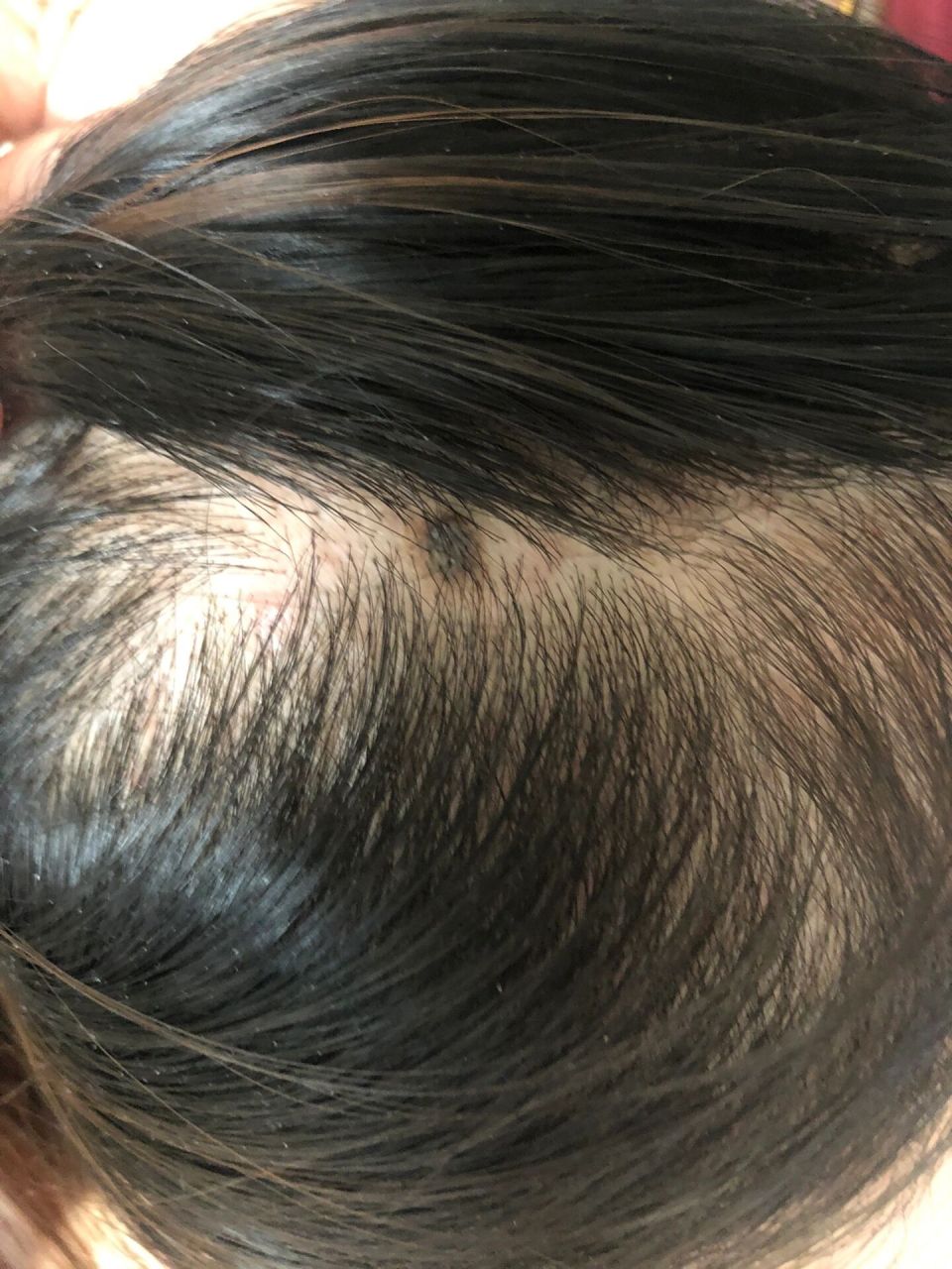 头皮有个痣,小时候就有不痛不痒的,有懂得会看的人帮忙看一下