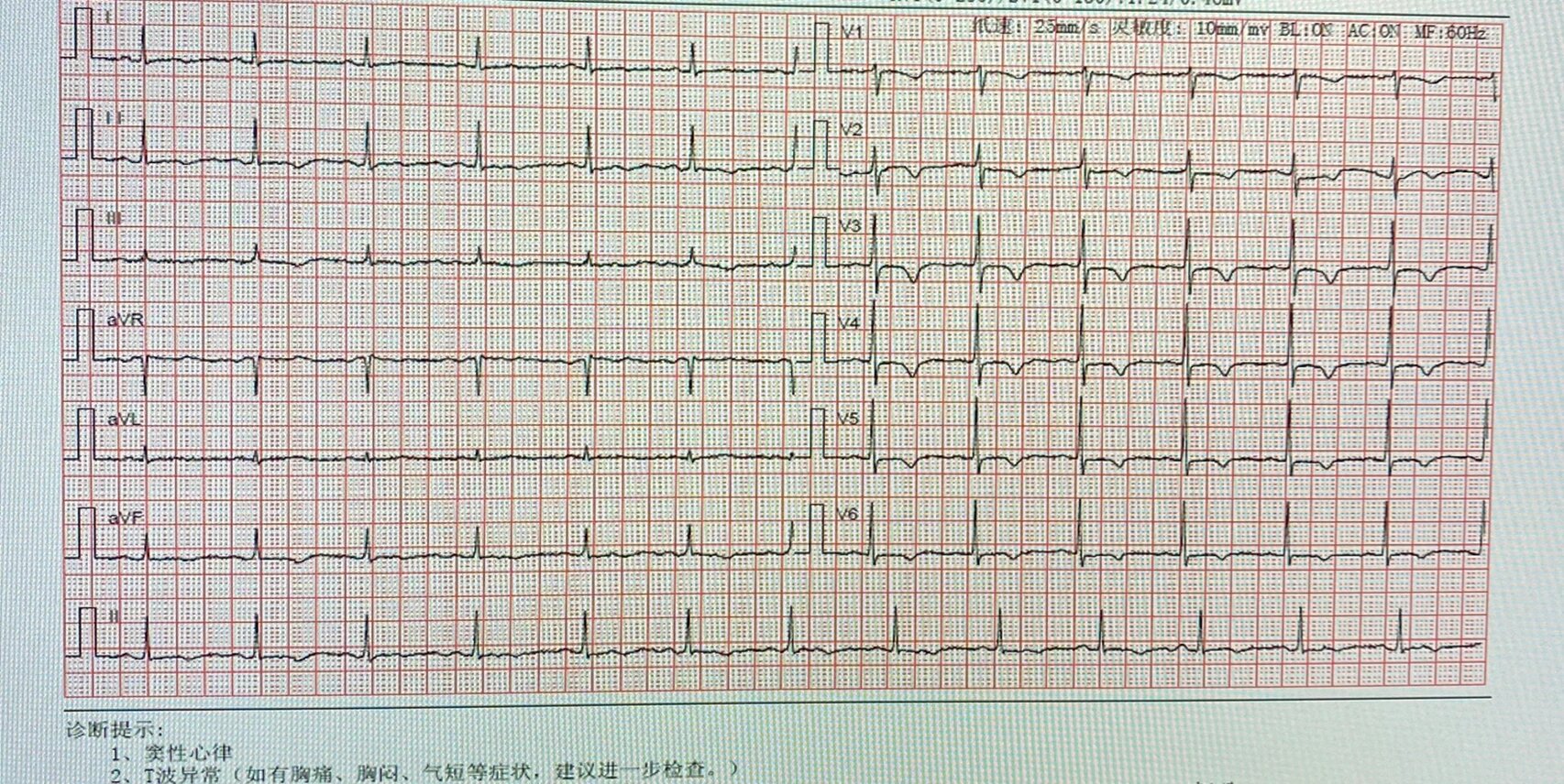 t波异常