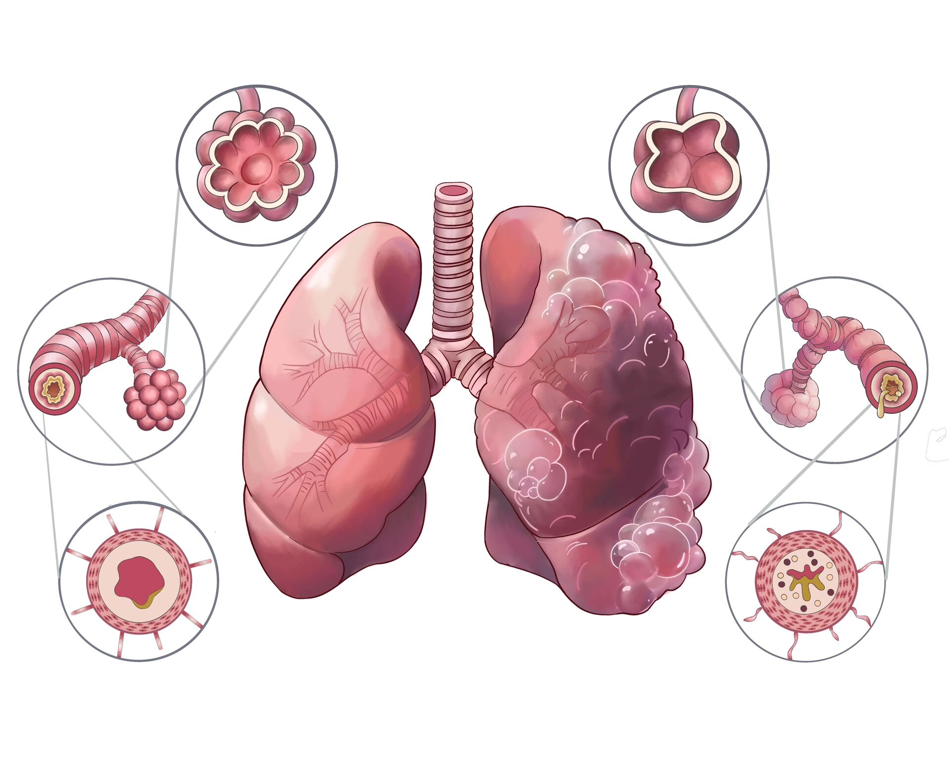 医学插画| 慢性阻塞性肺疾病(copd