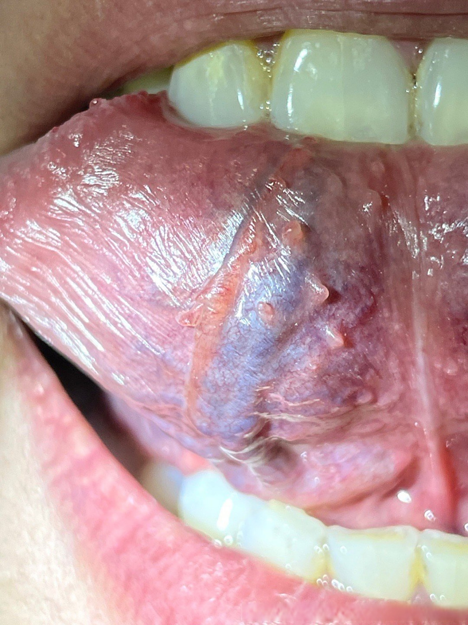 皮肤健康科普# 舌下的增生物是腺体,不是尖锐湿疣.