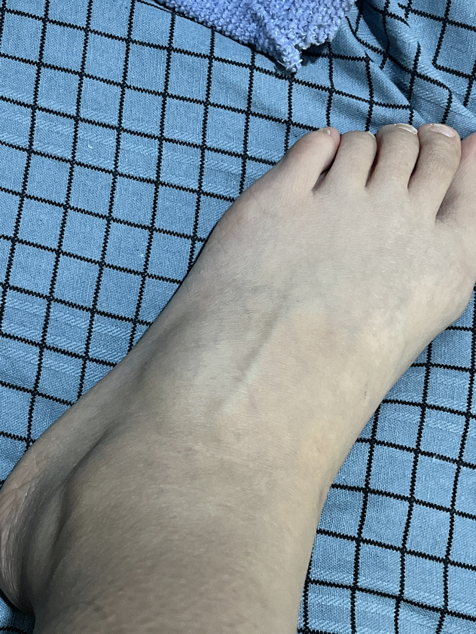 摔倒扭到脚背鼓包怎么办 今天晚上下台阶一不小心扭到脚摔了一跤,当时