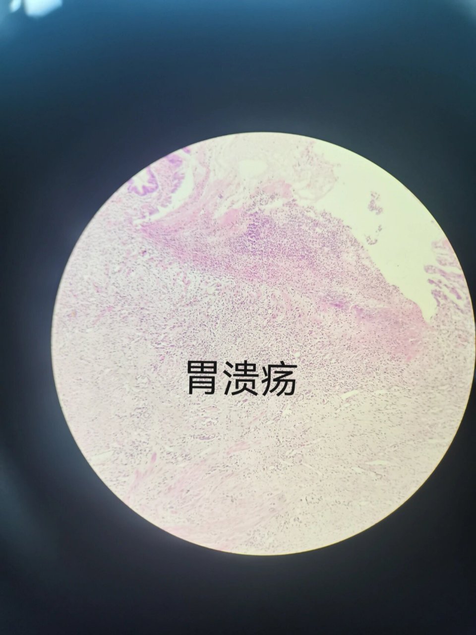 病理学|期末切片复习⑥ 95胃溃疡 镜下描述 ①低倍镜 可见胃粘膜上