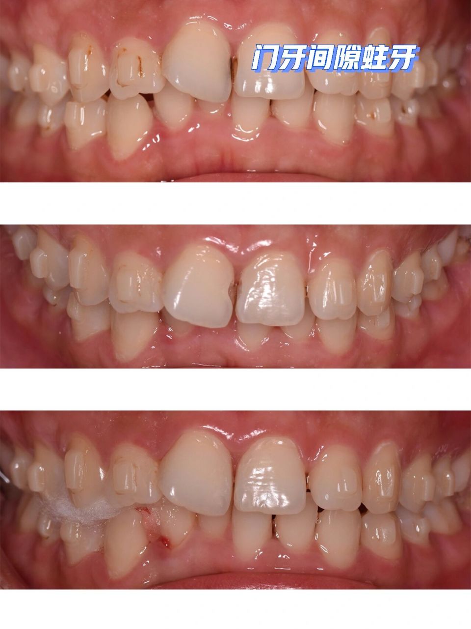 门牙蛀牙修补前后图片图片