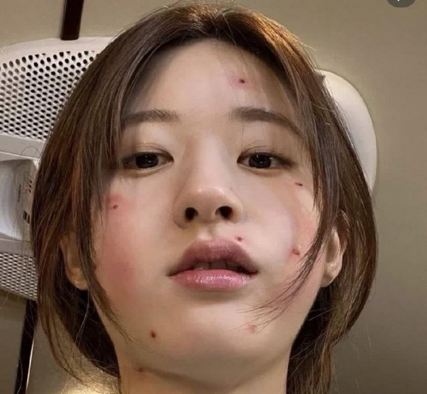 赵露思的脸怎么了,长痘痘了还是点痣?