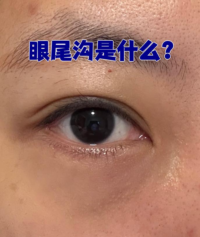 眼尾沟是指下眼睑靠近鼻侧的一条凹陷纹路,通常出现在卧蚕下方