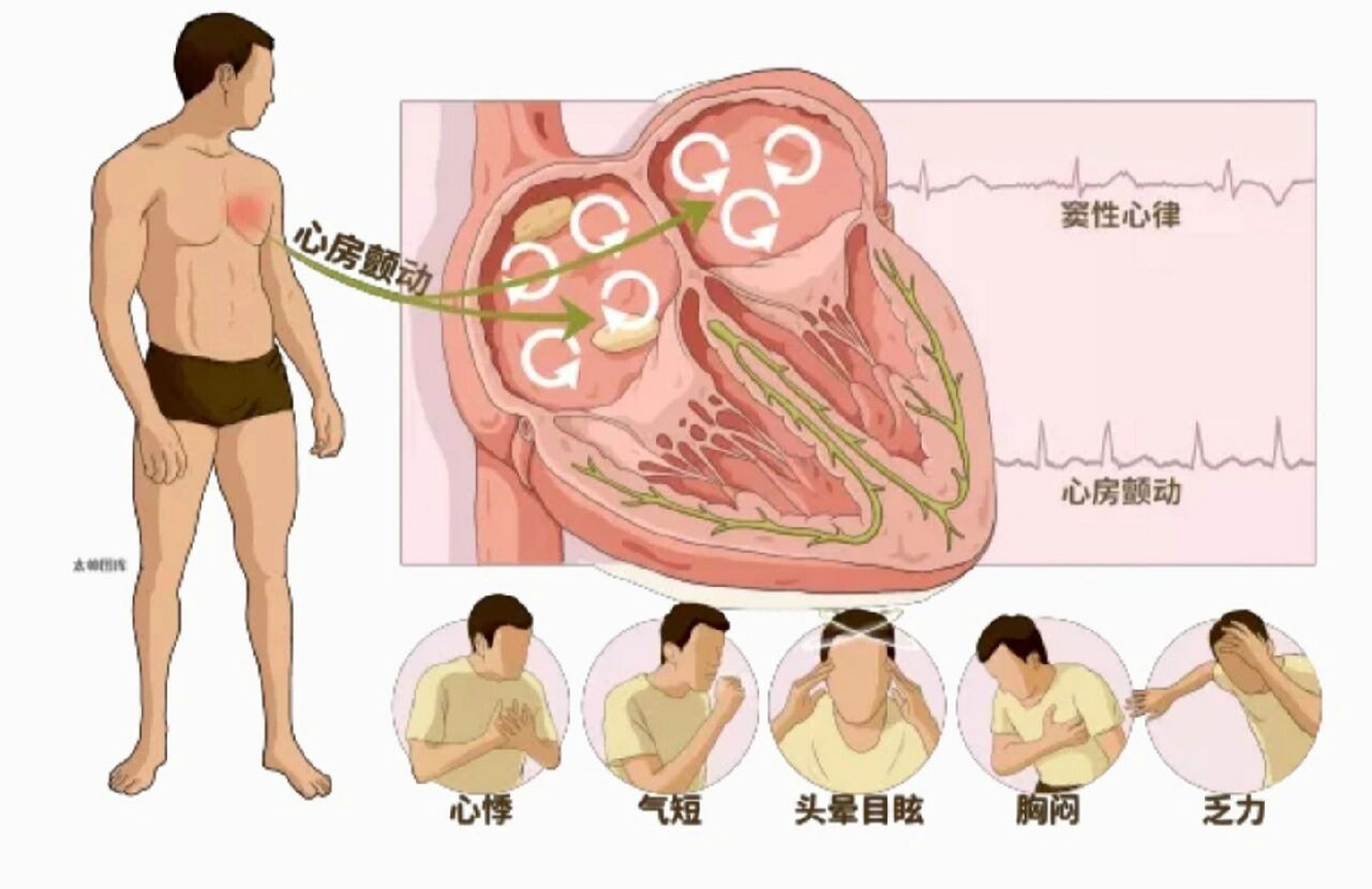 房颤的分类及机制 71房颤发生的三大机制 1.