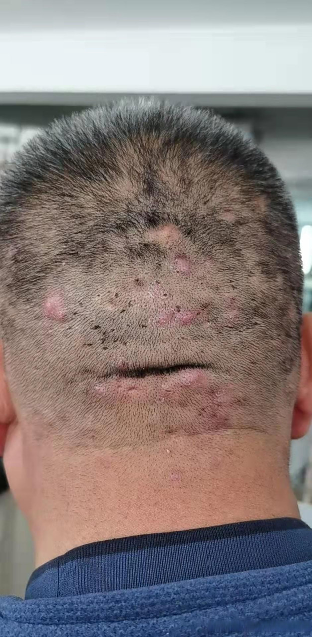 今天复诊了一位46岁的男患者,他已经忍受毛囊炎7年之久