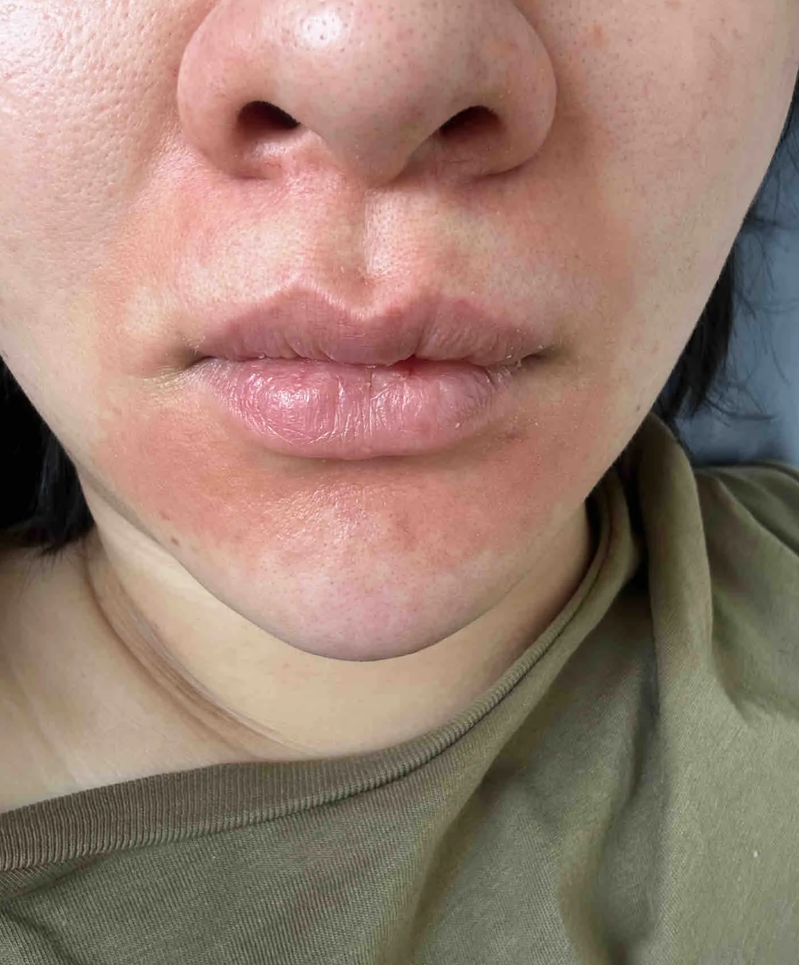 吃完海鲜后嘴巴周围痒,通常是因为对海鲜过敏了