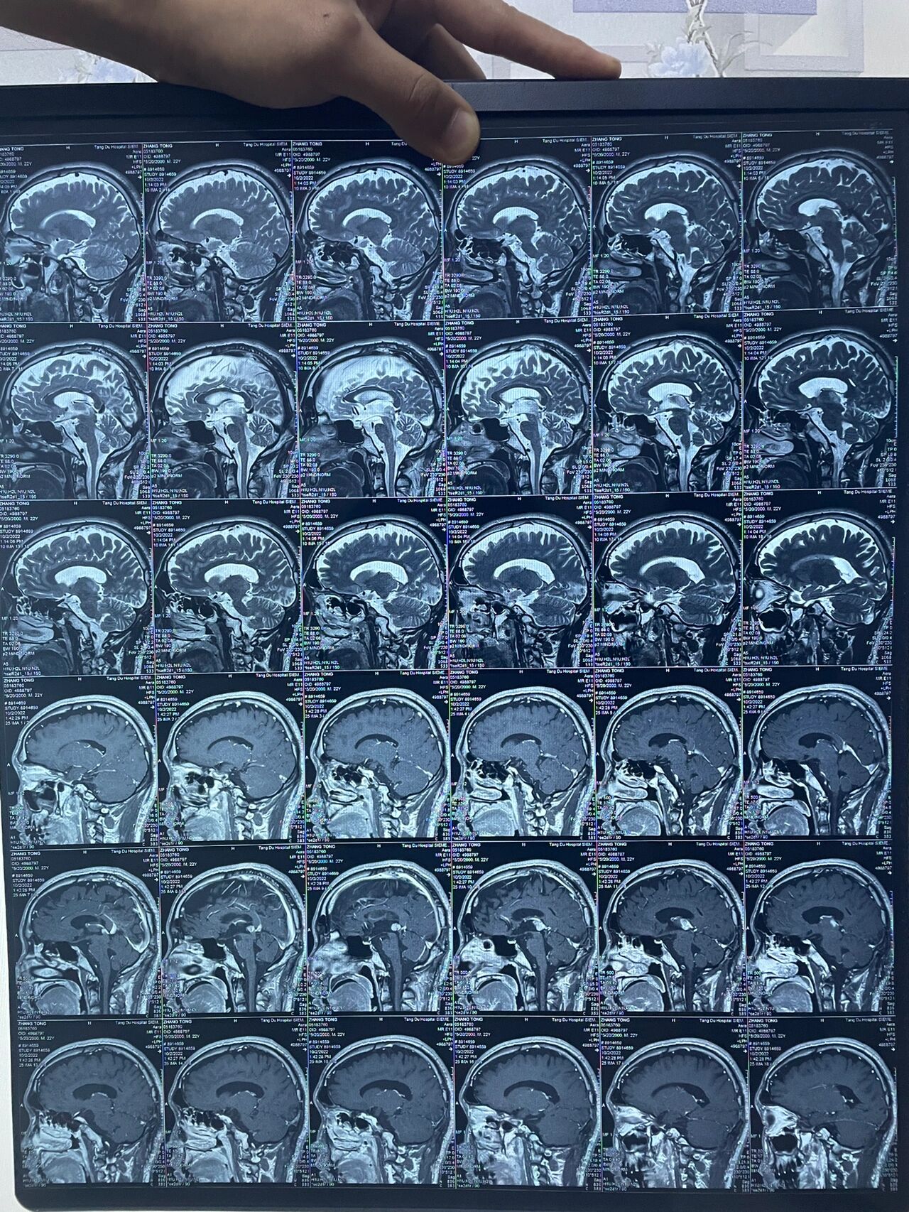 正常松果体核磁图片图片