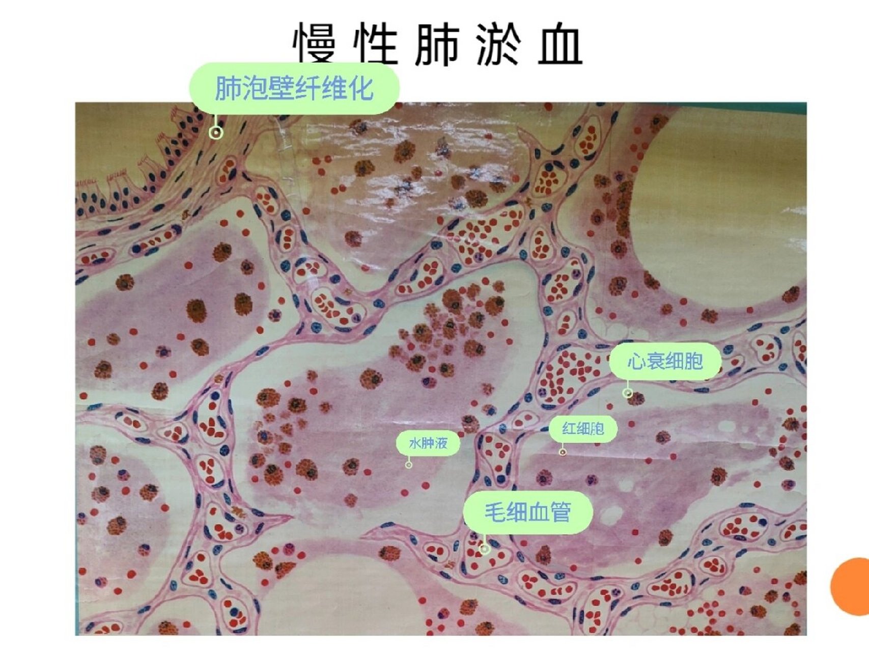 慢性肺淤血的镜下特点图片