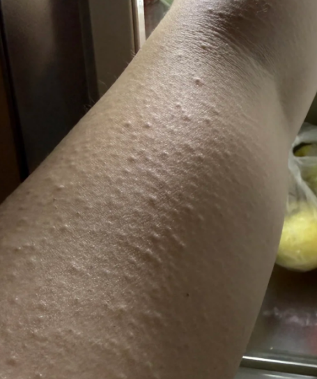 胳膊痒挠出小米粒样疙瘩最常见的原因是湿疹或荨麻疹,这两种情况