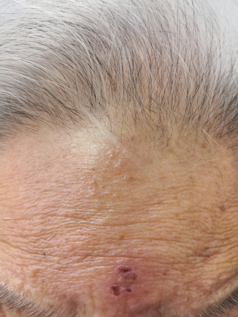 老年女性的额头带状疱疹症状.#带状疱疹##解决皮肤问题专注皮肤美容