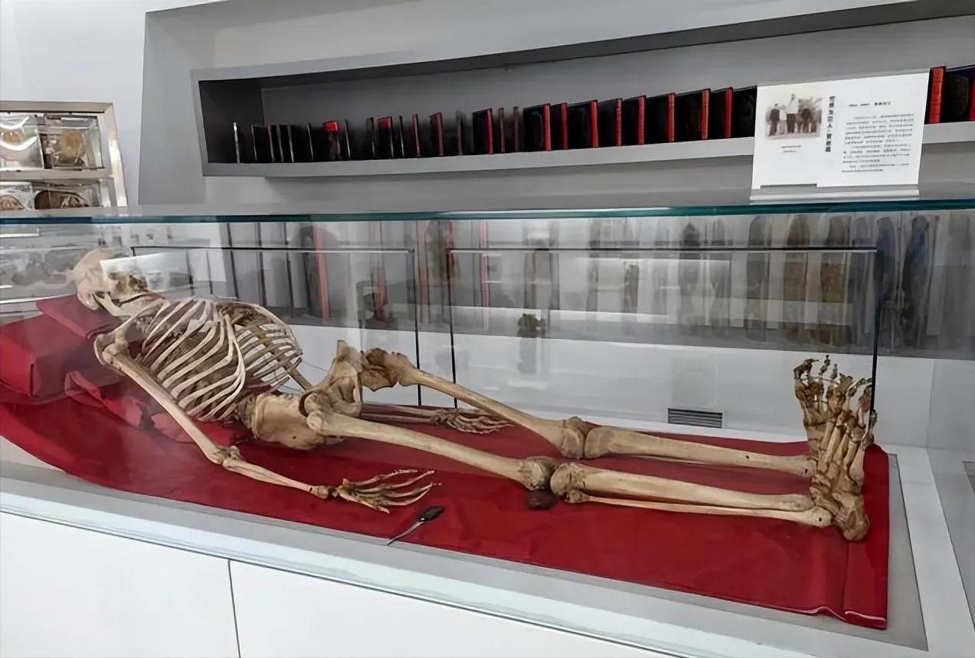 2005年,湖南湘雅医学院的标本室里,放着中国"第一女巨人"曾金莲的遗体