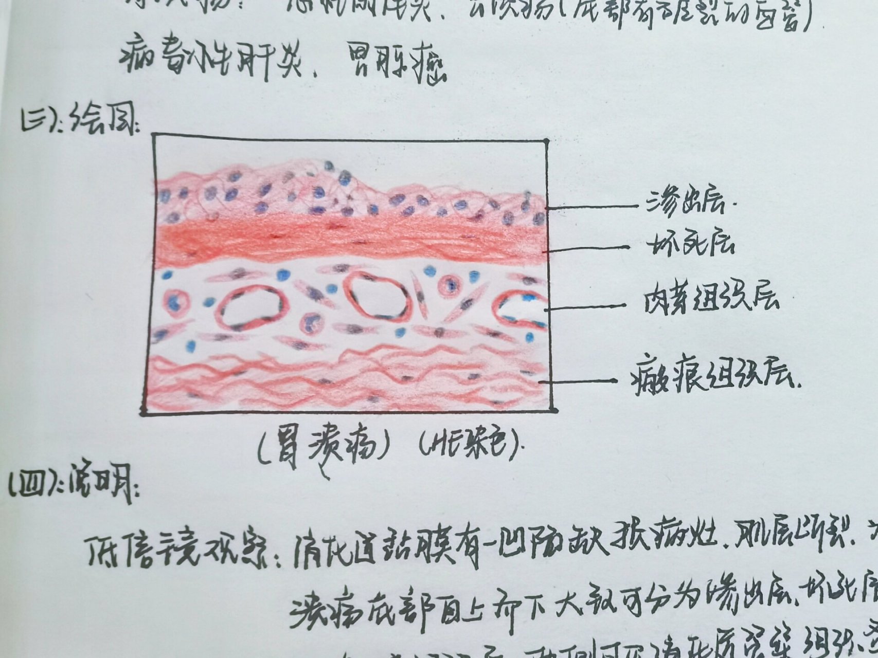 胃溃疡病理手绘图图片