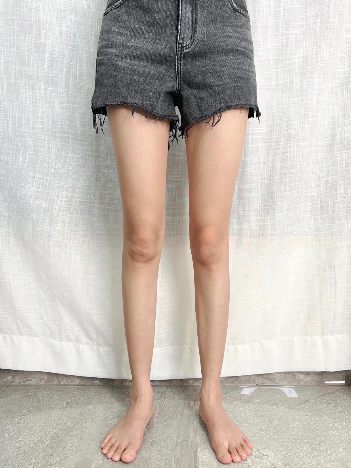 膝内侧凸导致腿不直✅5个动作教你改善