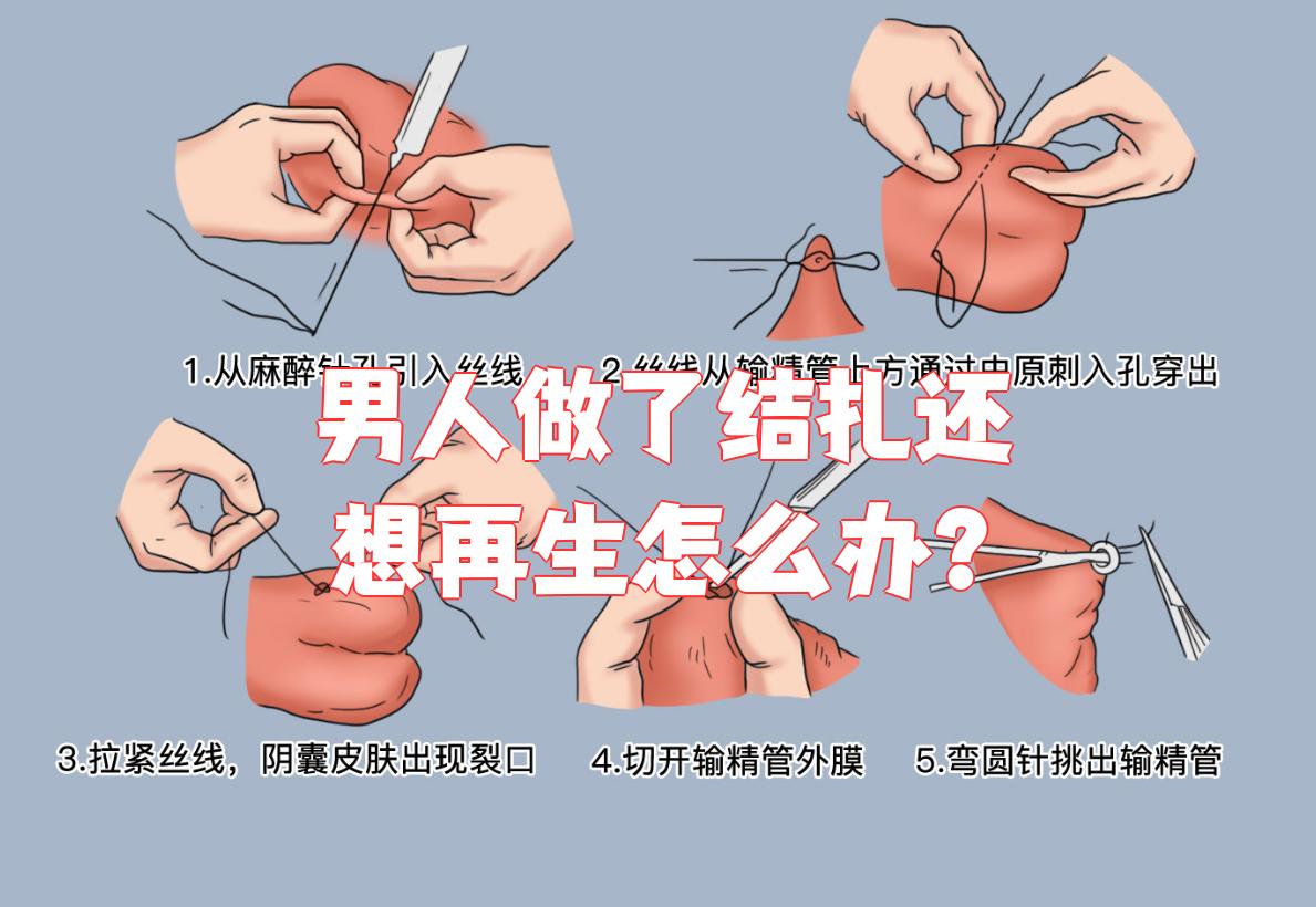 男人结扎后想再要孩子的话,主要有两种办法:输精管复通术和试管婴儿