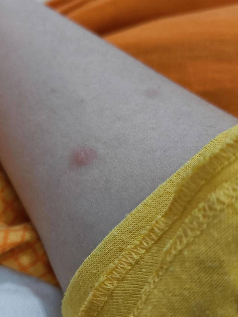 第一天 我也不晓得今天算不算是第一天,前两天胸前有几颗红疹没有水泡