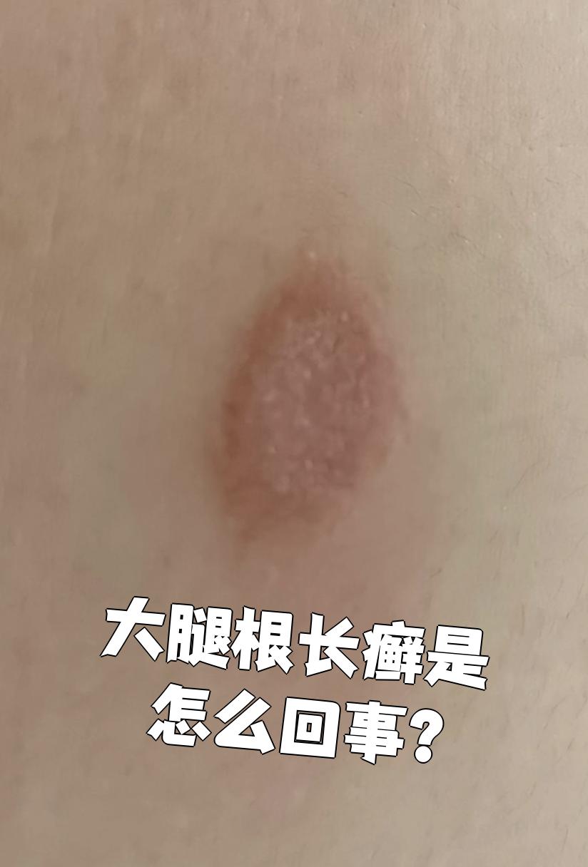 如果总穿湿衣服或者出汗多,大腿根部的皮肤可能感染真菌.这时候