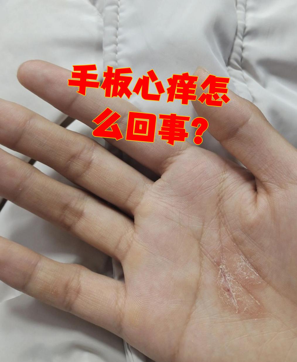 食物或药物过敏都可能诱发,导致手心痒,伴有红斑,风团等症状