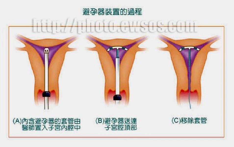 宫腔型节育环的图片图片