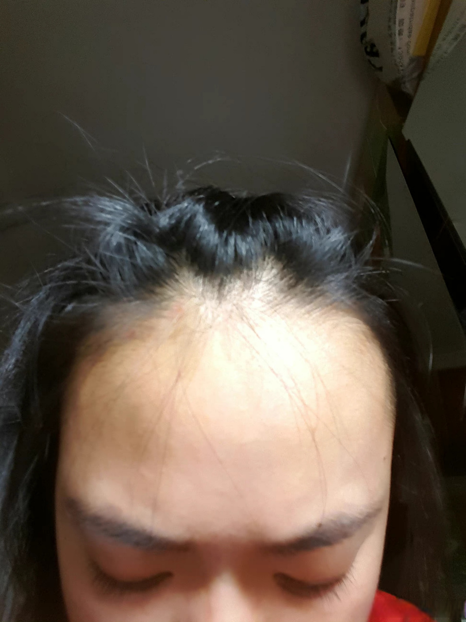 #植发际线前后对比