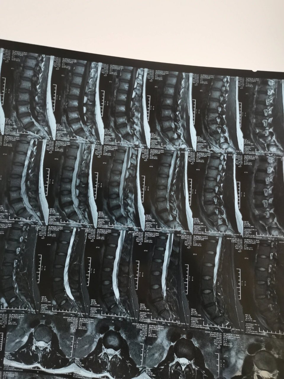 腰4-5椎间盘膨出!