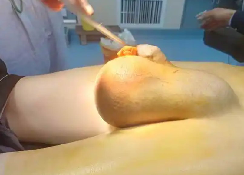 阴囊积液在小孩身上很常见,主要是因为鞘状突没闭合造成的