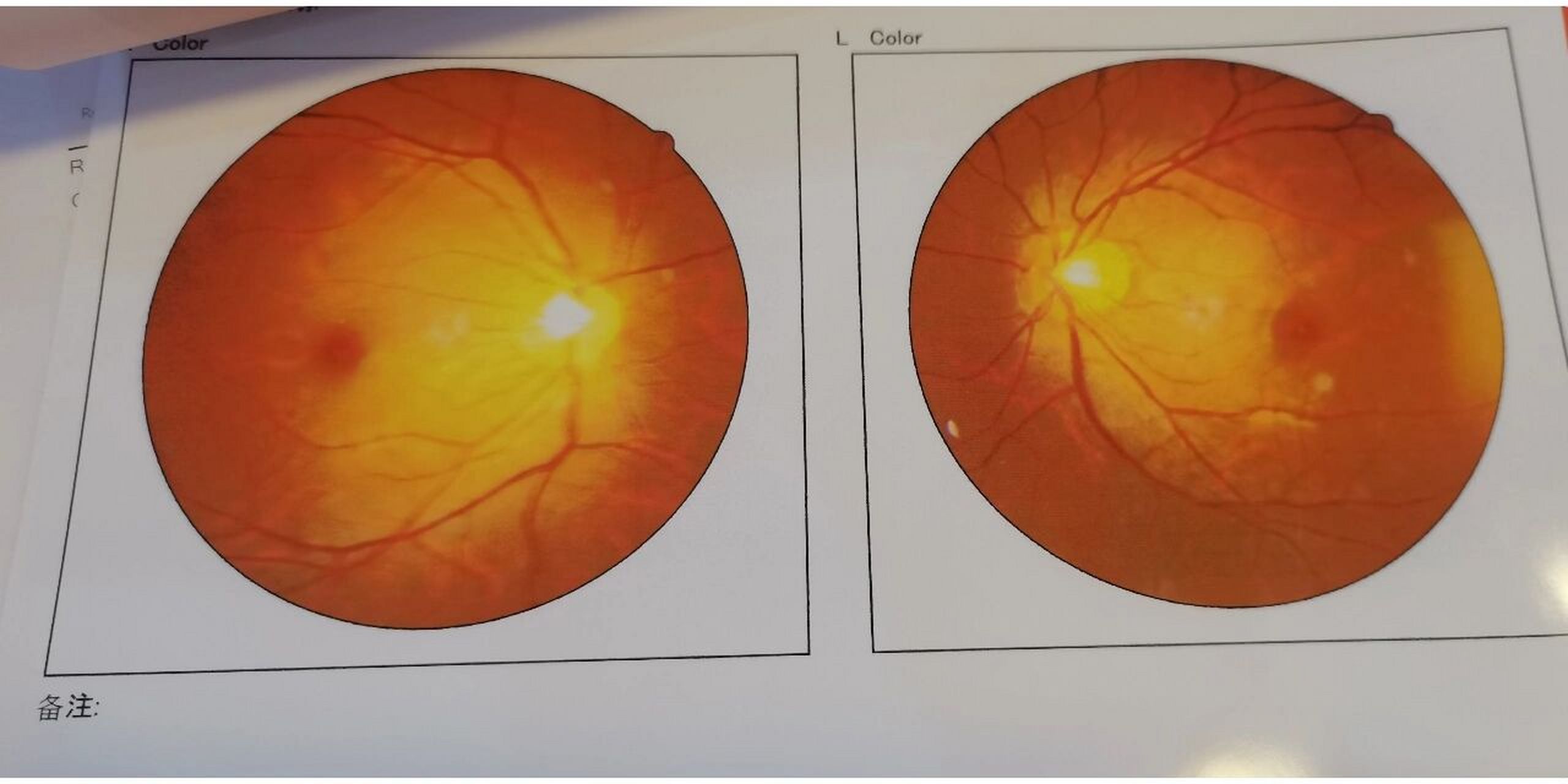 高度近视的我今天终于鼓起勇气去做了眼底检查,刚开始先是裂隙灯检查