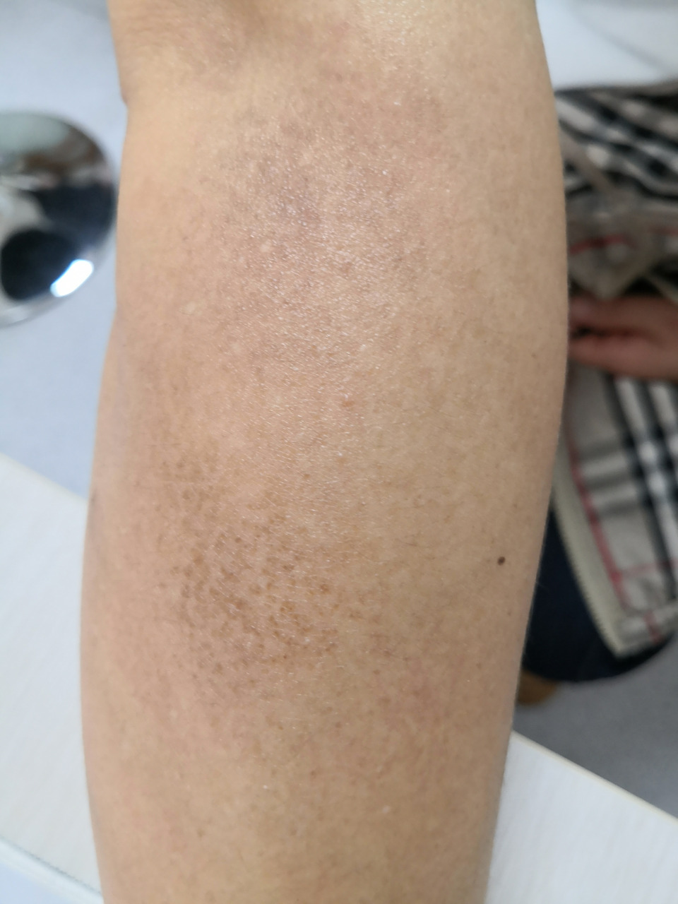 手臂黑褐色斑片.考虑色素沉着过度症状.活检排查一下诊断比较好.
