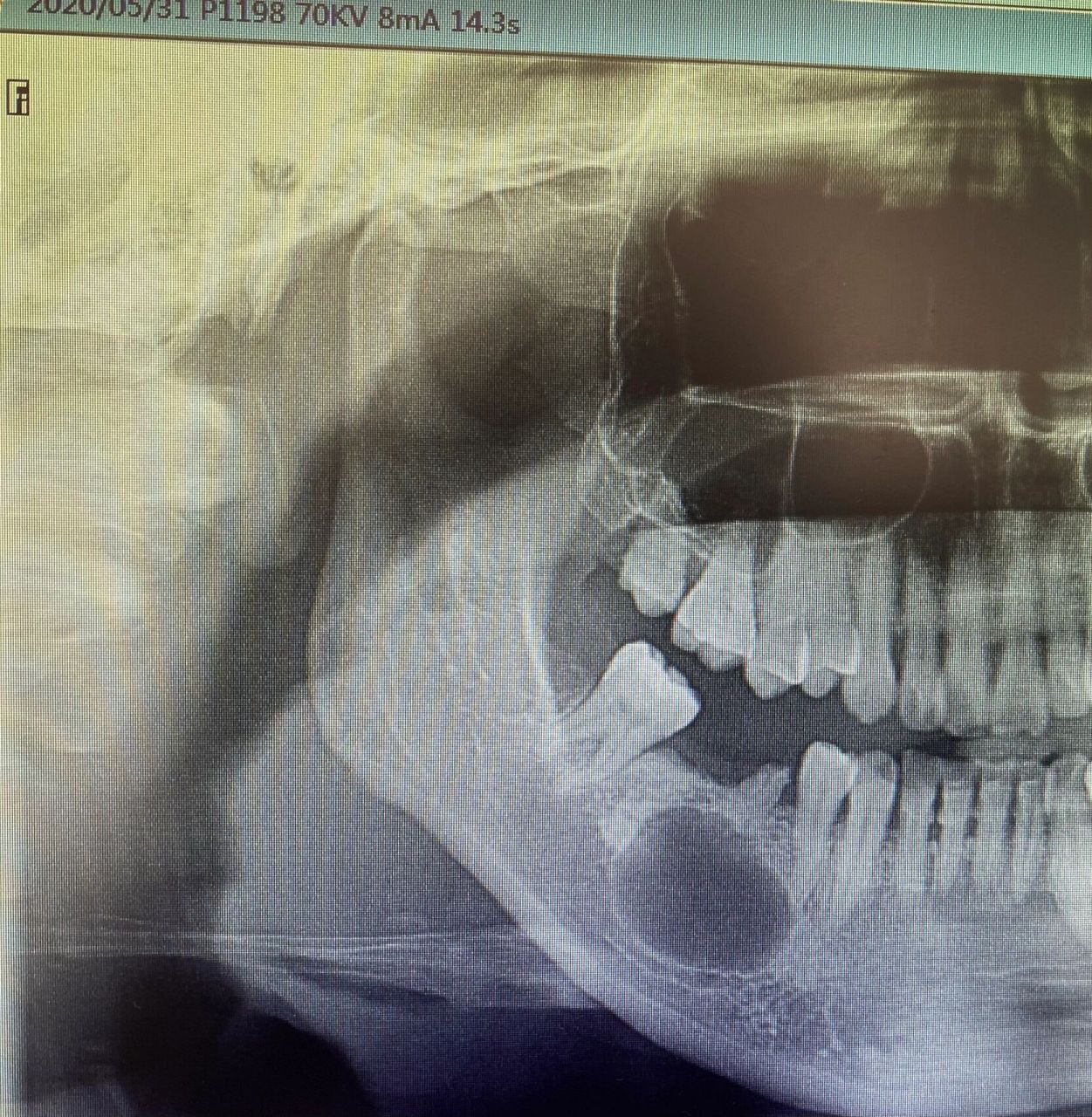 牙骨囊肿图片