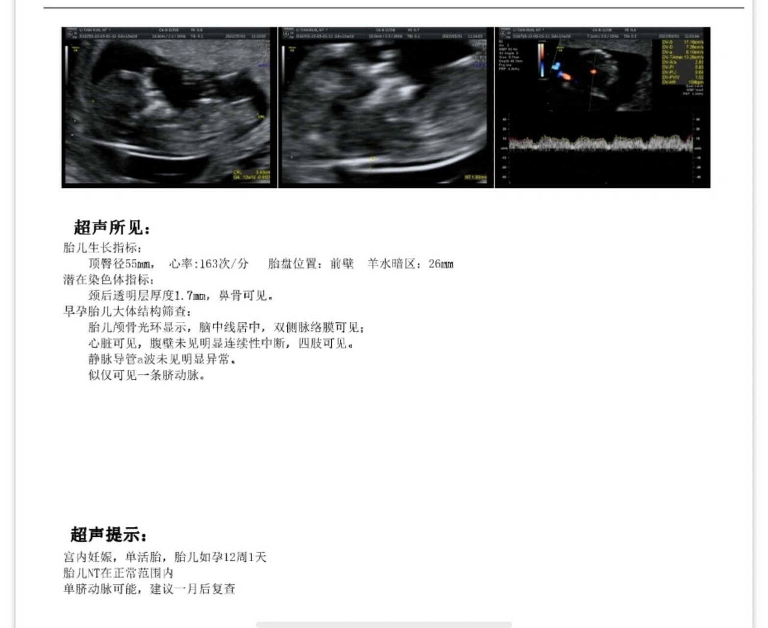 大家快接 12周做nt秒过,但是显示单脐动脉可能,16周复查显示双脐动脉!