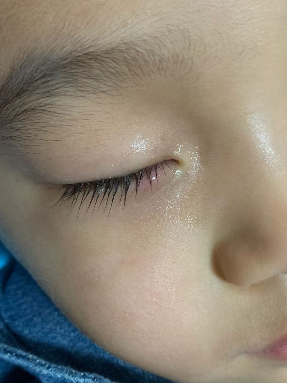 其实挺不敢相信的,2岁半的宝宝竟然长针眼(麦粒肿)了,今天来给大家