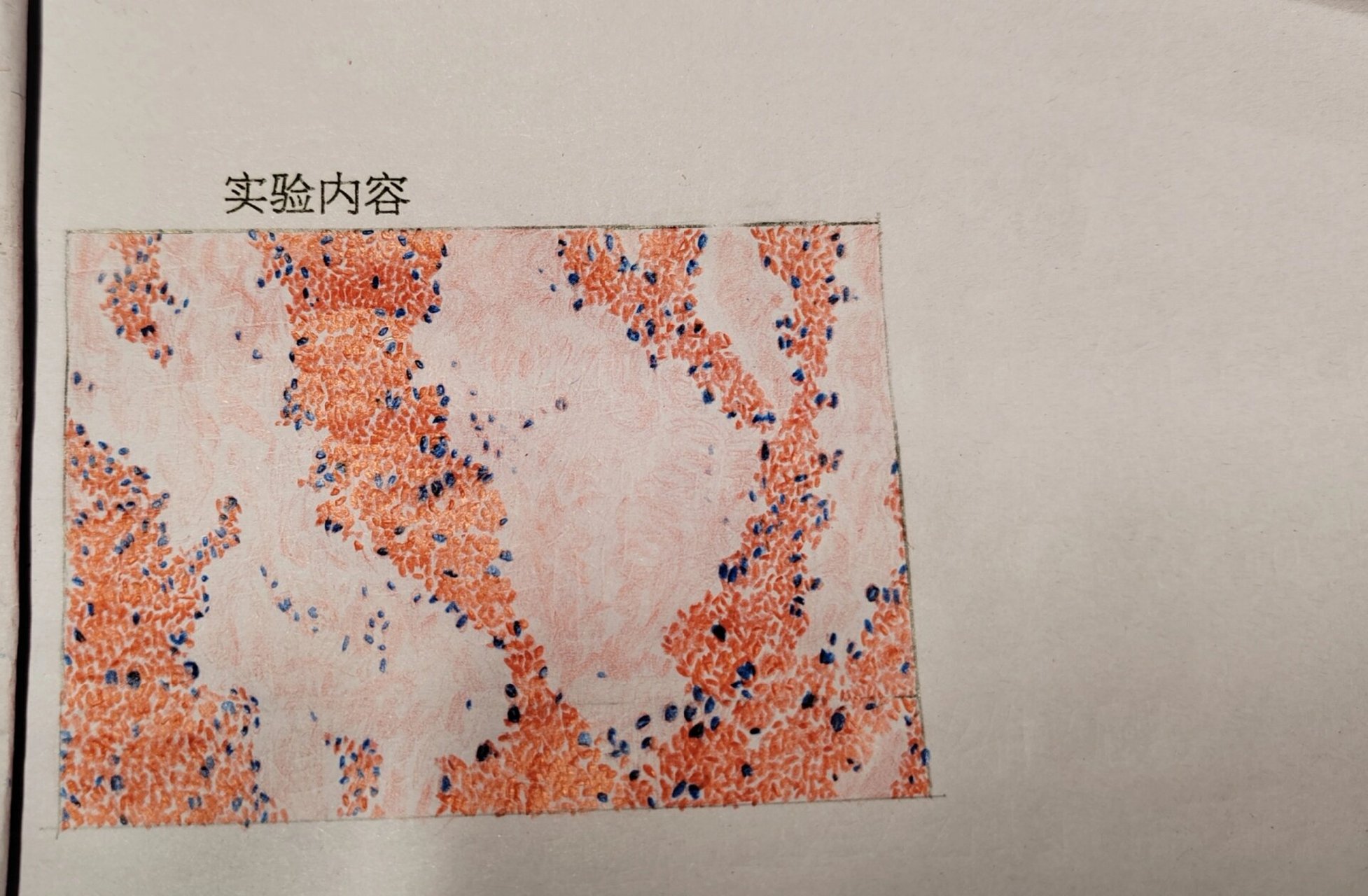 红蓝铅笔绘图病理混合血栓