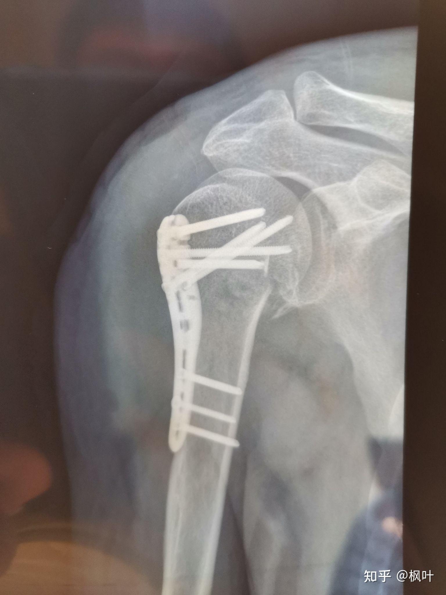 胳膊骨折手术钢板固定三个月了还有些麻痛什么原因