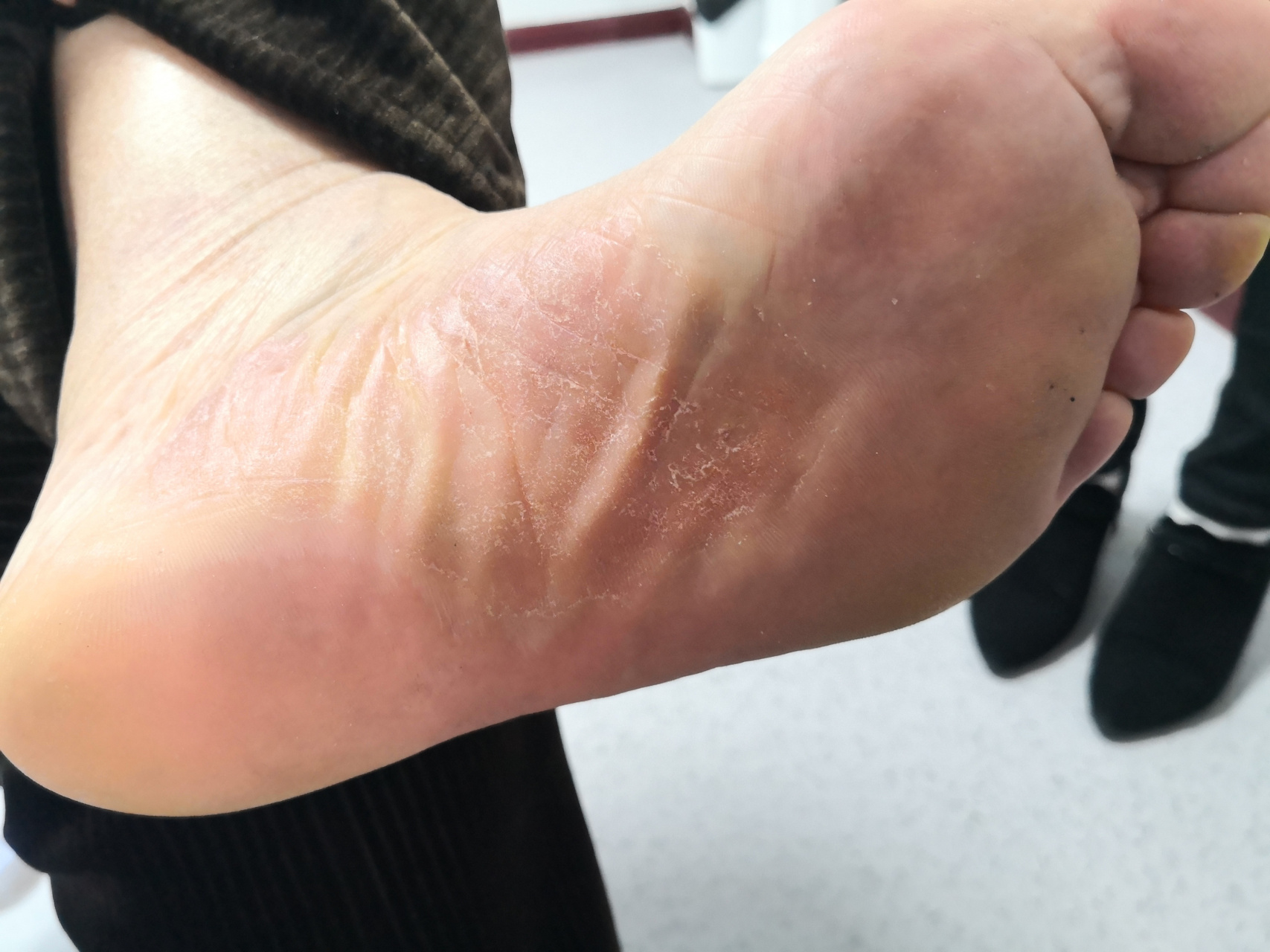 考虑角化型湿疹,要排查一下真菌感染引起的角化型足癣可能#足癣