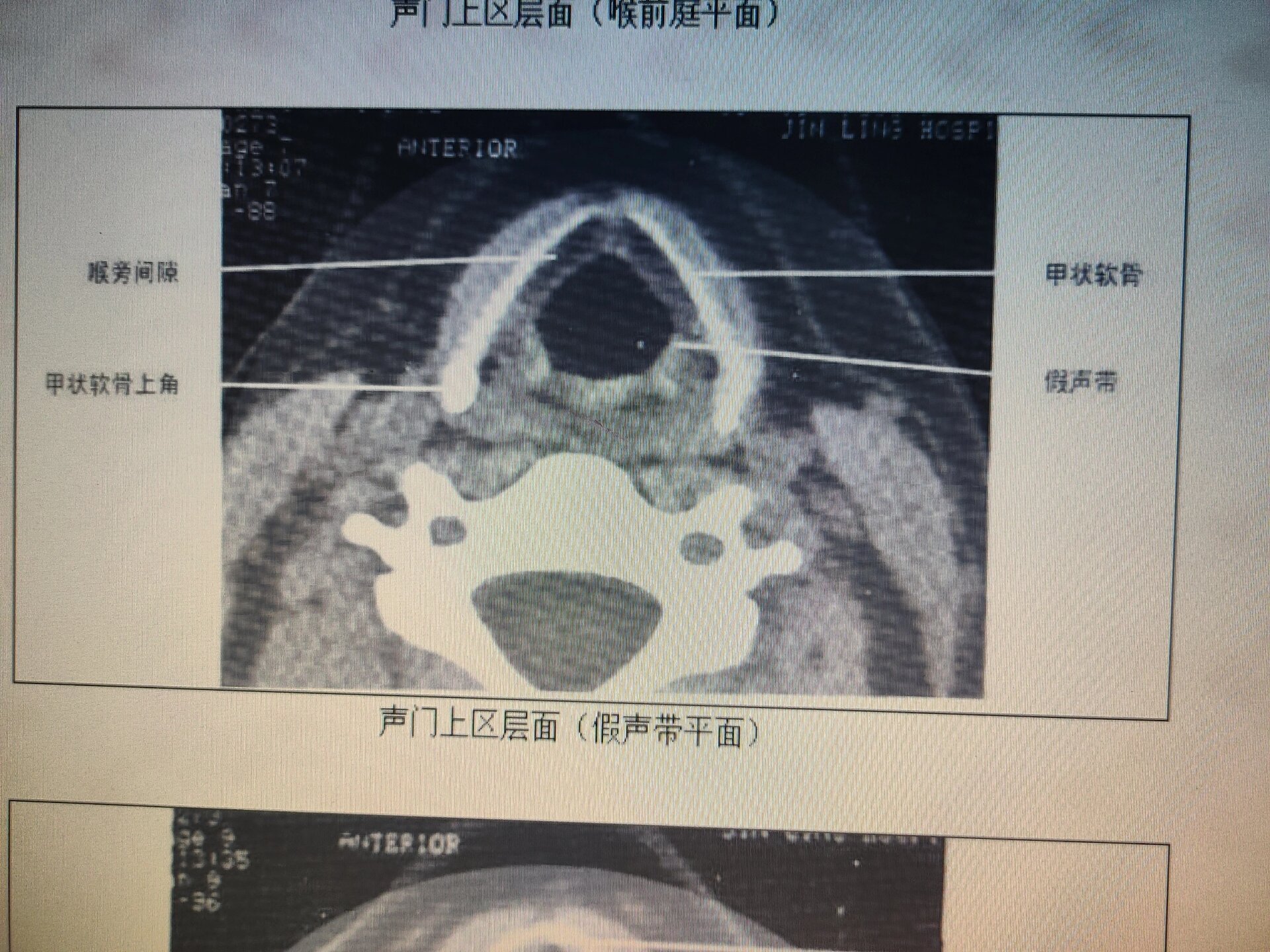 声门CT图片