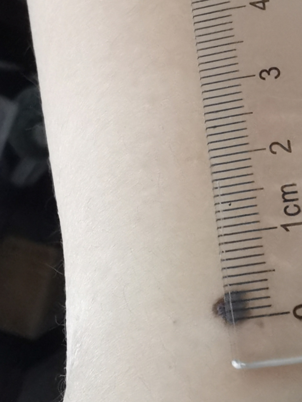 胳膊上的大黑痣 需要切除吗 左侧胳膊有个大痣,凸起,从小就有,这么多