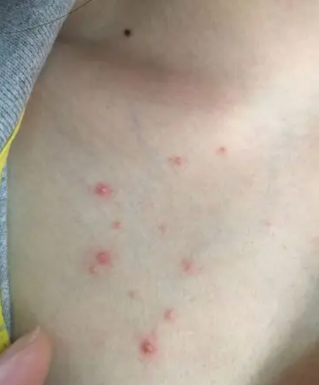 胸上长小疙瘩最常见的原因有毛囊炎,脂囊瘤,脂