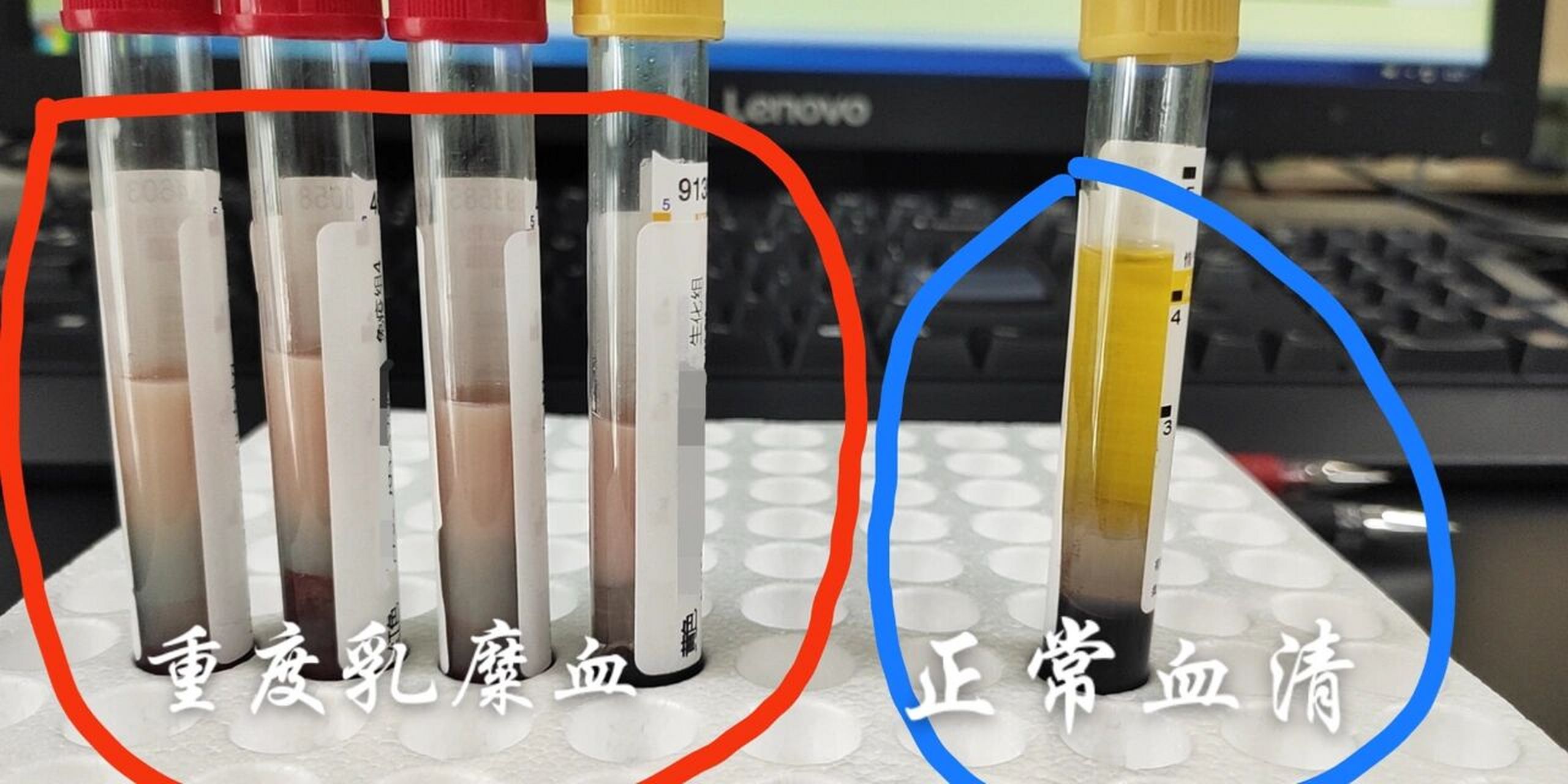 科普09 客户和朋友一起来体检,却发现三人的血清都是重度乳糜血75