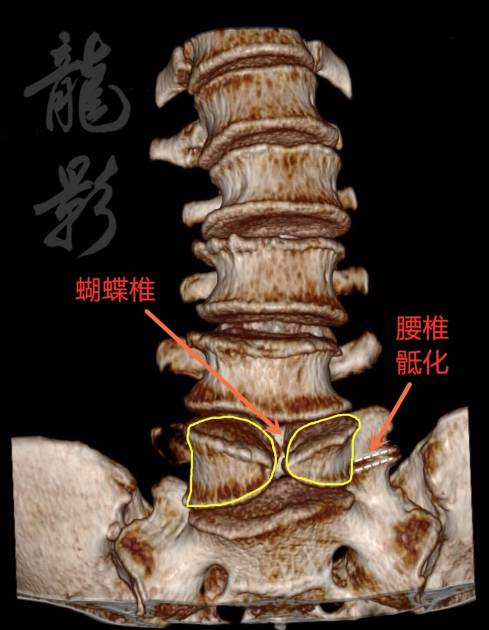 椎体楔形变图片