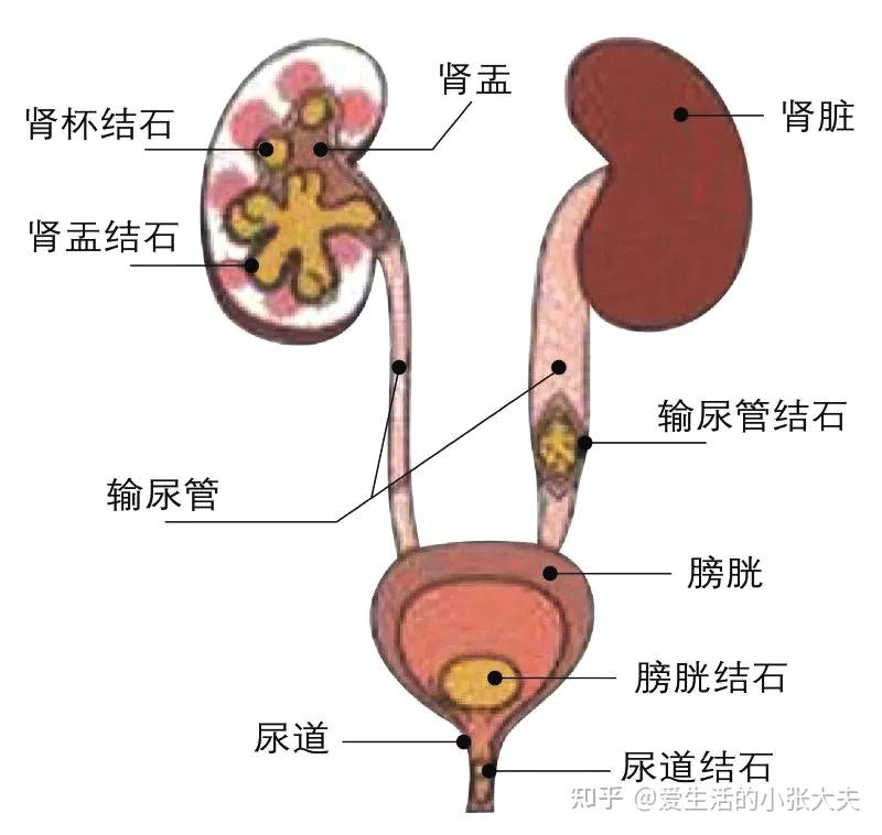 泌尿系结石高发图片