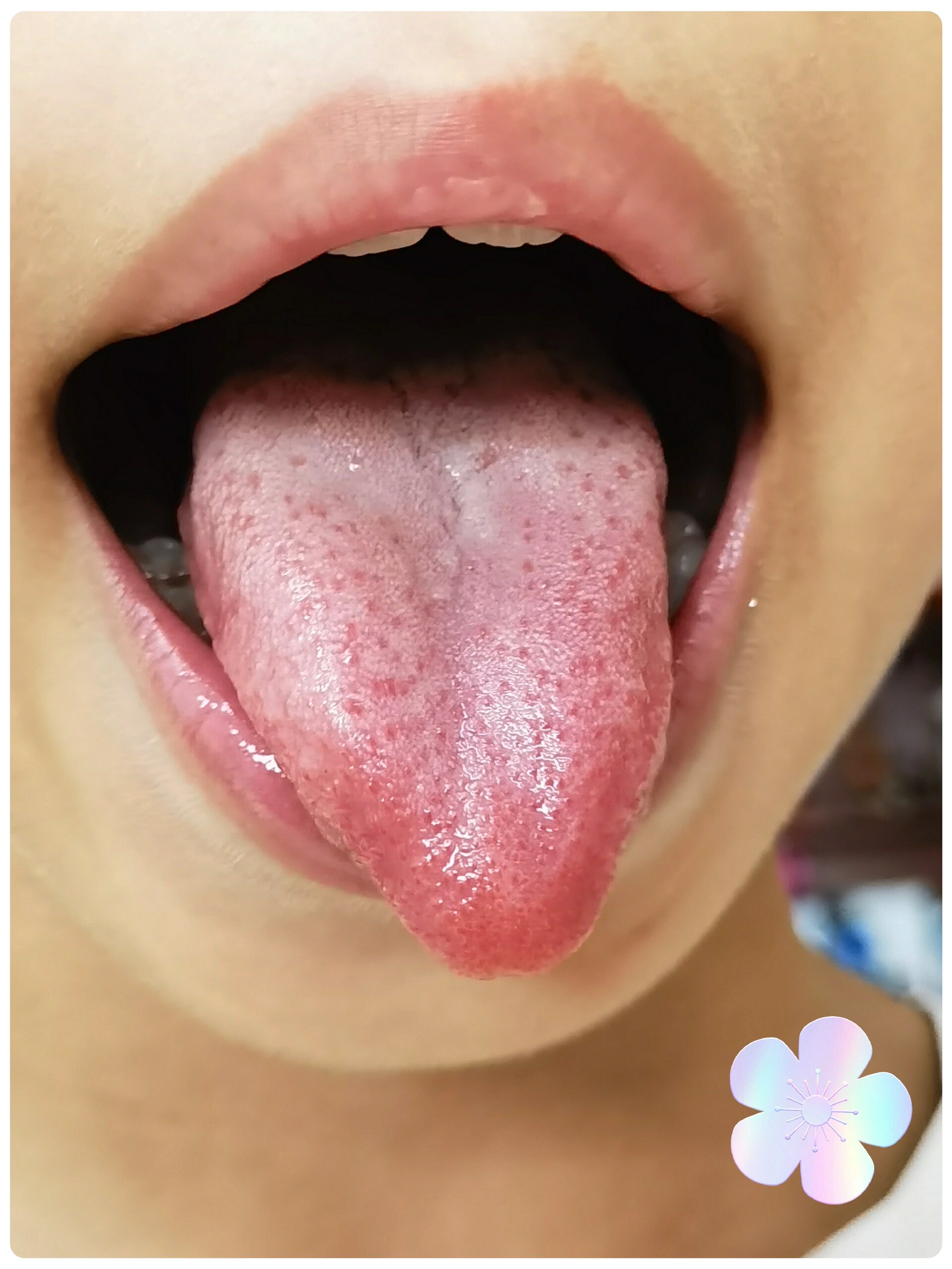 舌苔白厚? 舌尖红?