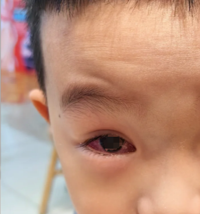 眼睛里有血通常是因为血管破裂或充血,常见原因分两类: