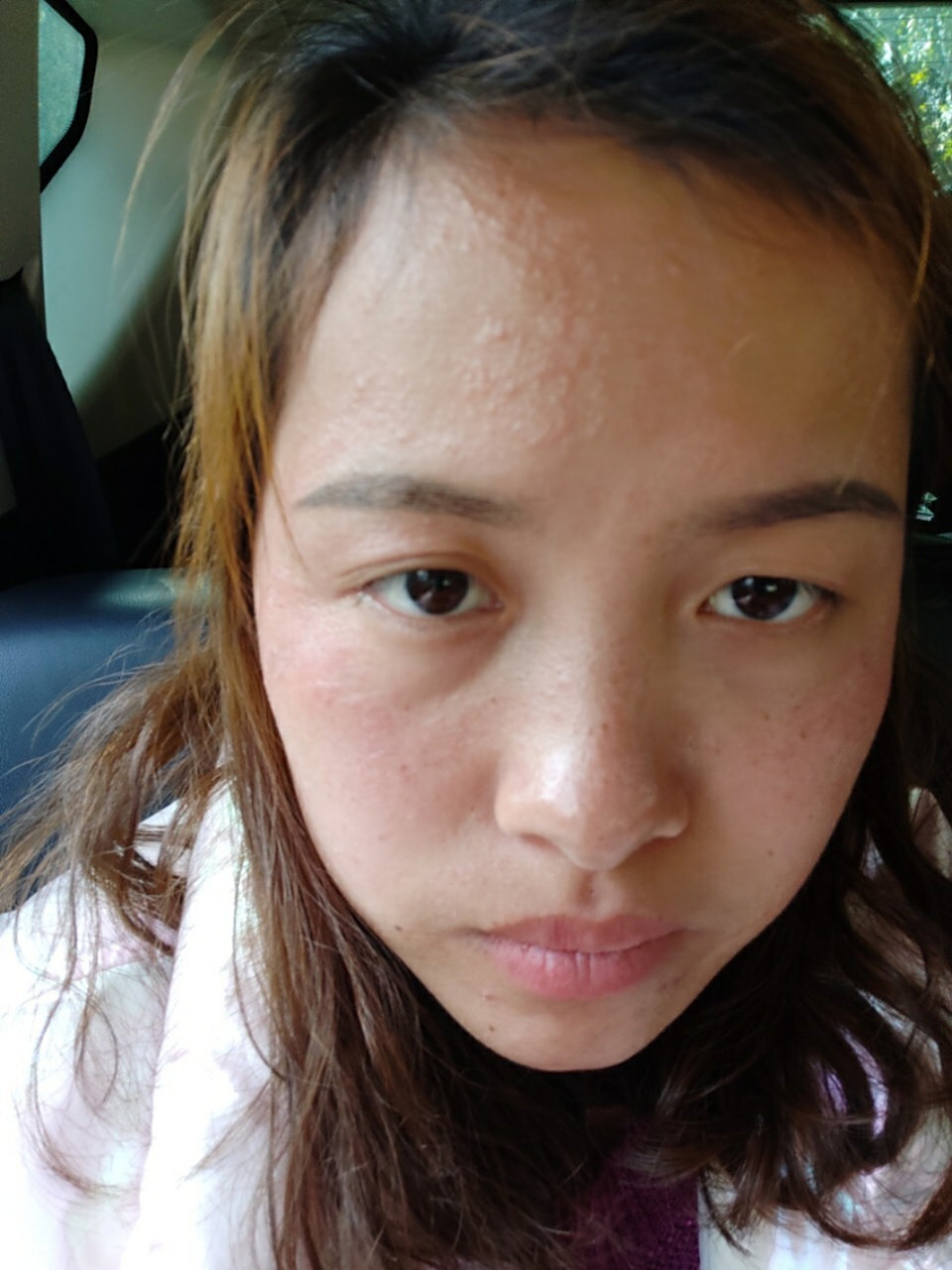 脸过敏,额头好长了好多跟痱子一样的东西用什么药好呢?