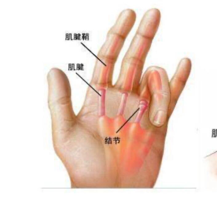 手掌腱鞘炎怎么治疗图片