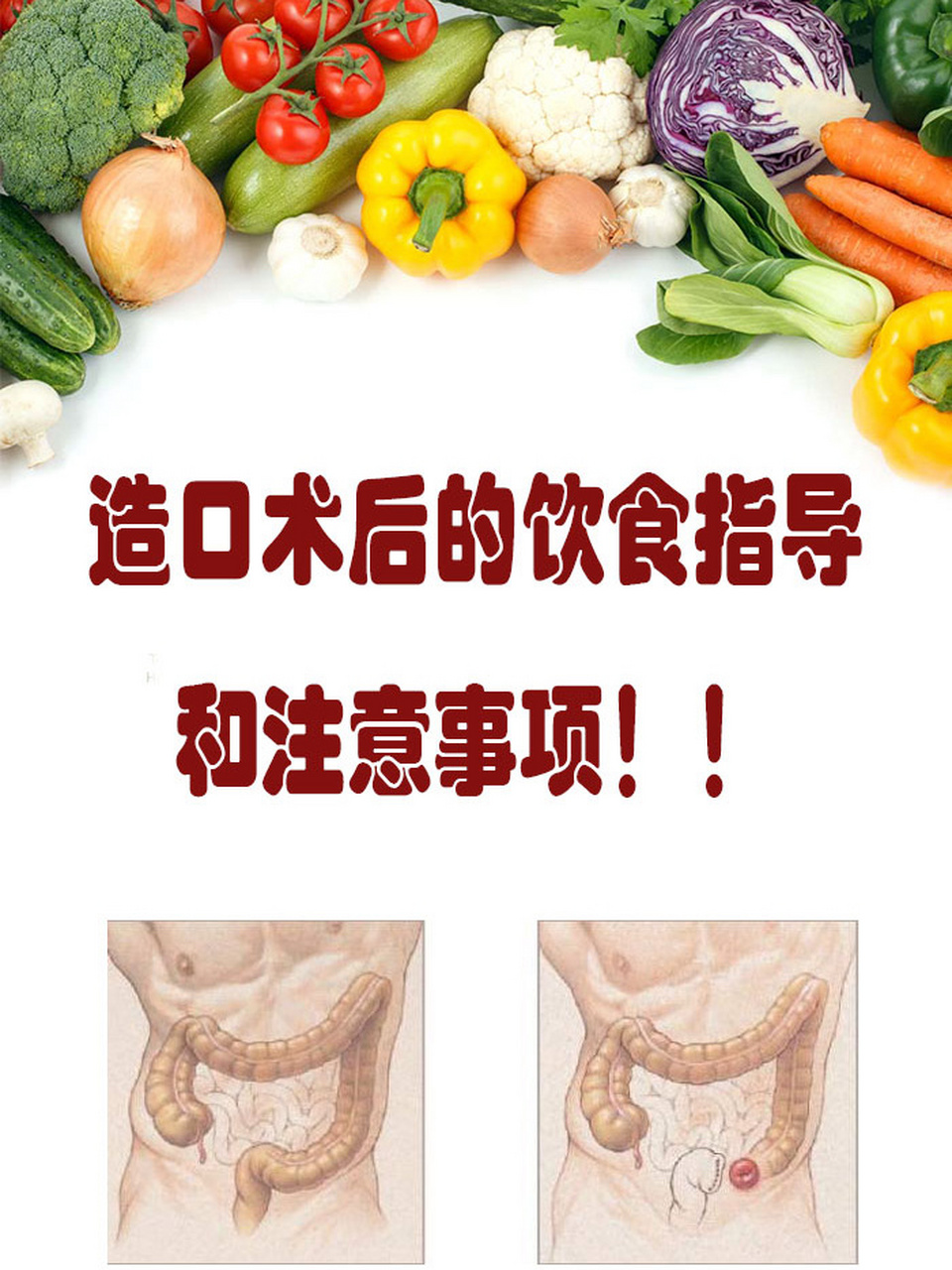 7215(必看)| 造口手术后的饮食指导02 1,少进食产气食物因为肠