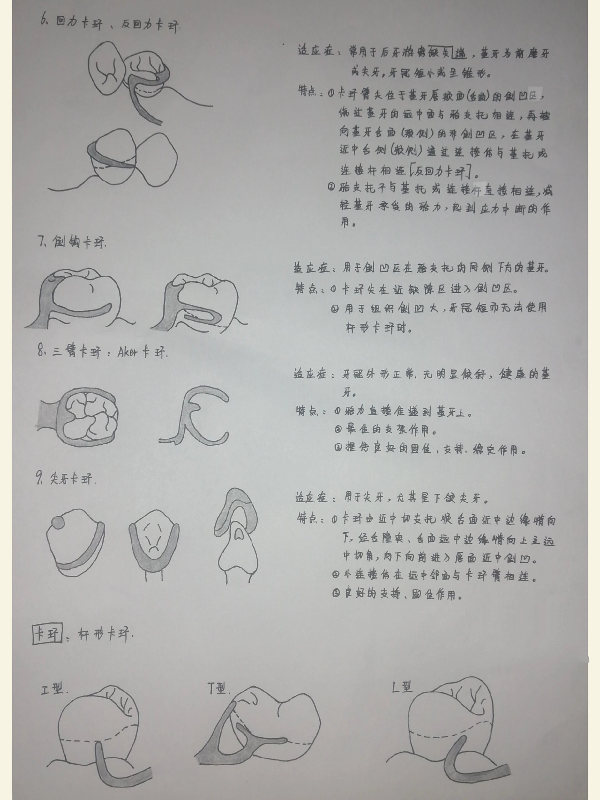 口腔修复----各种卡环